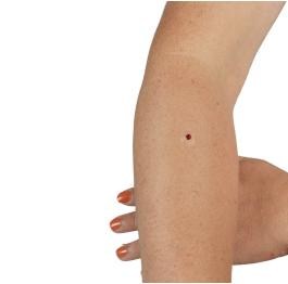 A puncture wound