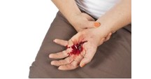 Bleeding is usually minor in nature but can sometimes impose serious threat if a large vein or artery has been injured. 