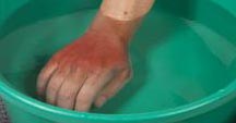 Contact with any source of heat can cause a burn or scald injury. A burn can result from contact with a heat source such as hot metal or electricity, hot liquid or steam.