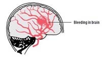 A stroke is a condition in which part of the brain is affected by an interruption to the normal blood supply. This can result from a clot in a blood vessel that stops blood passing through to brain tissue. If this condition is recognised at an early stage and hospital care is readily available, drug treatment is able to dissolve the clot, resulting in a full recovery.