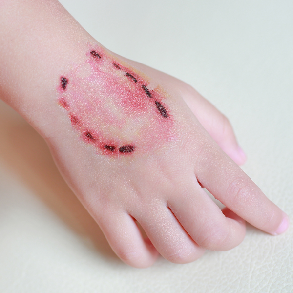 Child's hand with bite wound