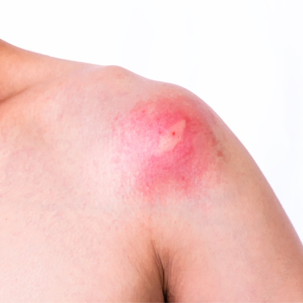 Child's shoulder with inflamed spider bite