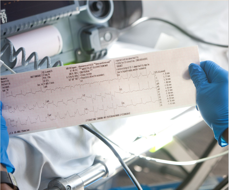 STEMI reading